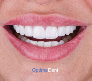 Optima Dent